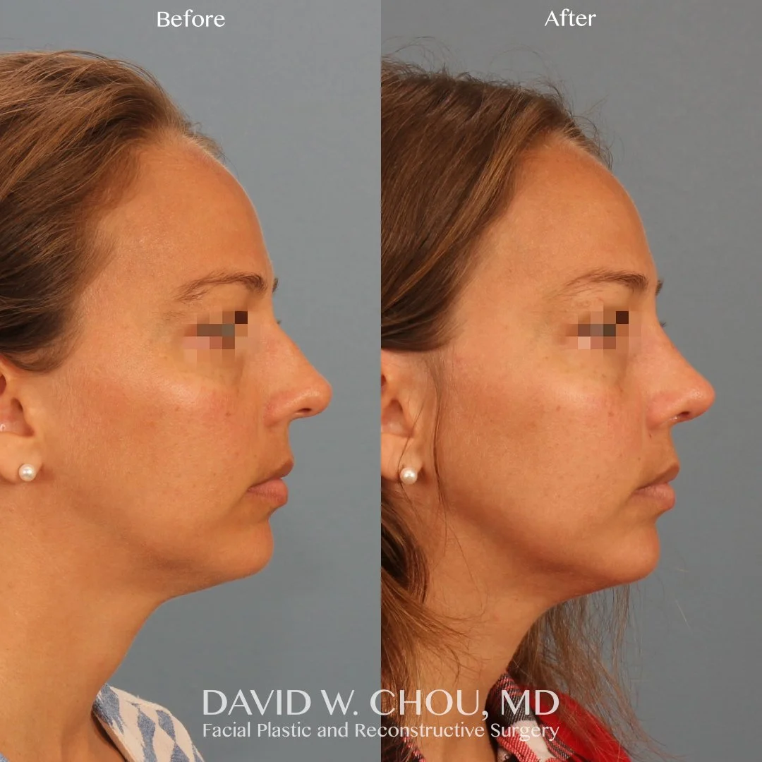 right lateral blur.jpg