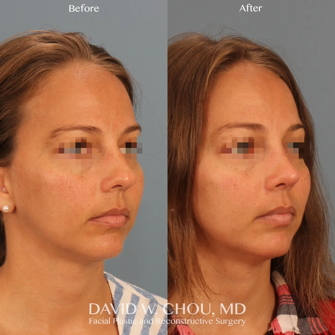 right oblique blur.jpg