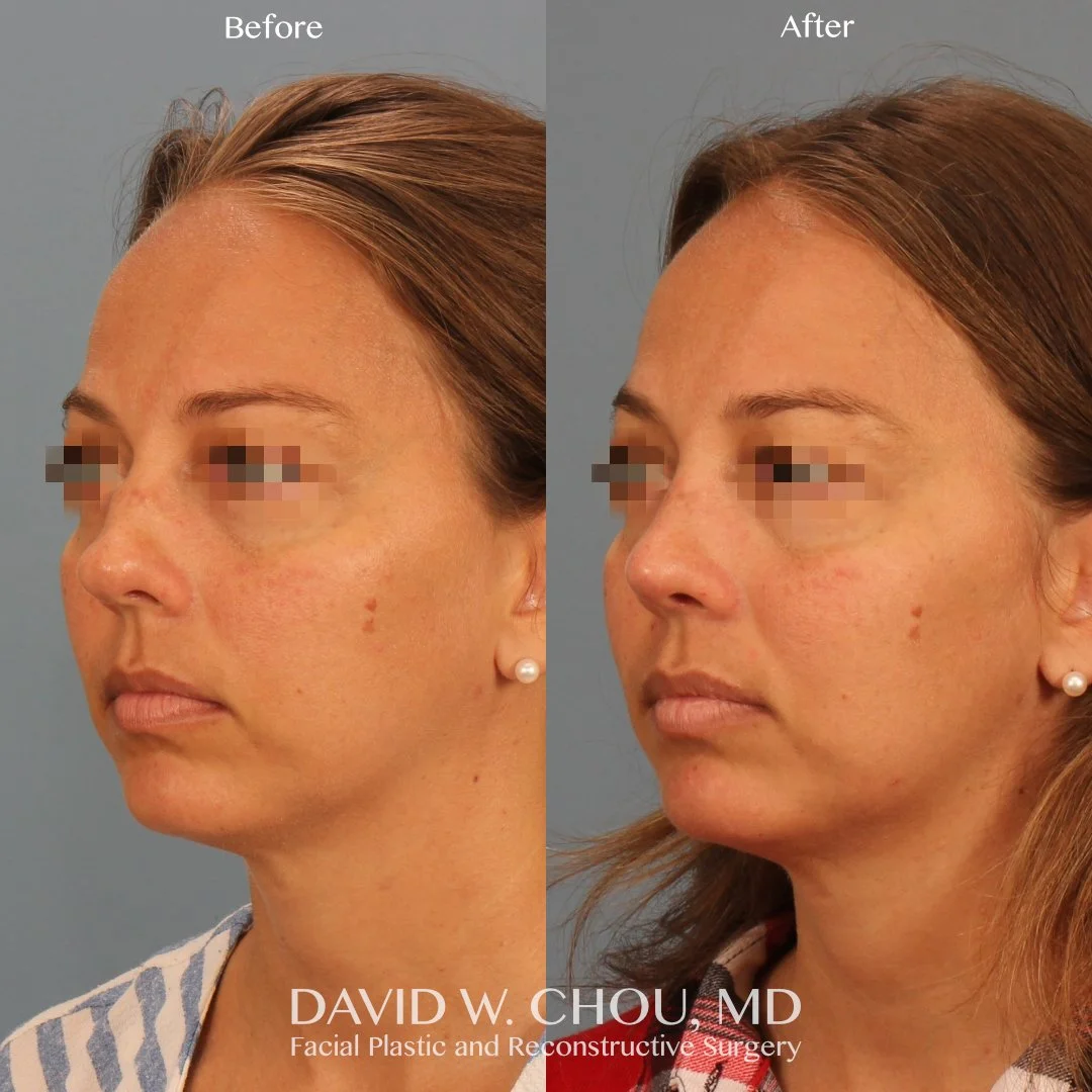 left oblique blur.jpg