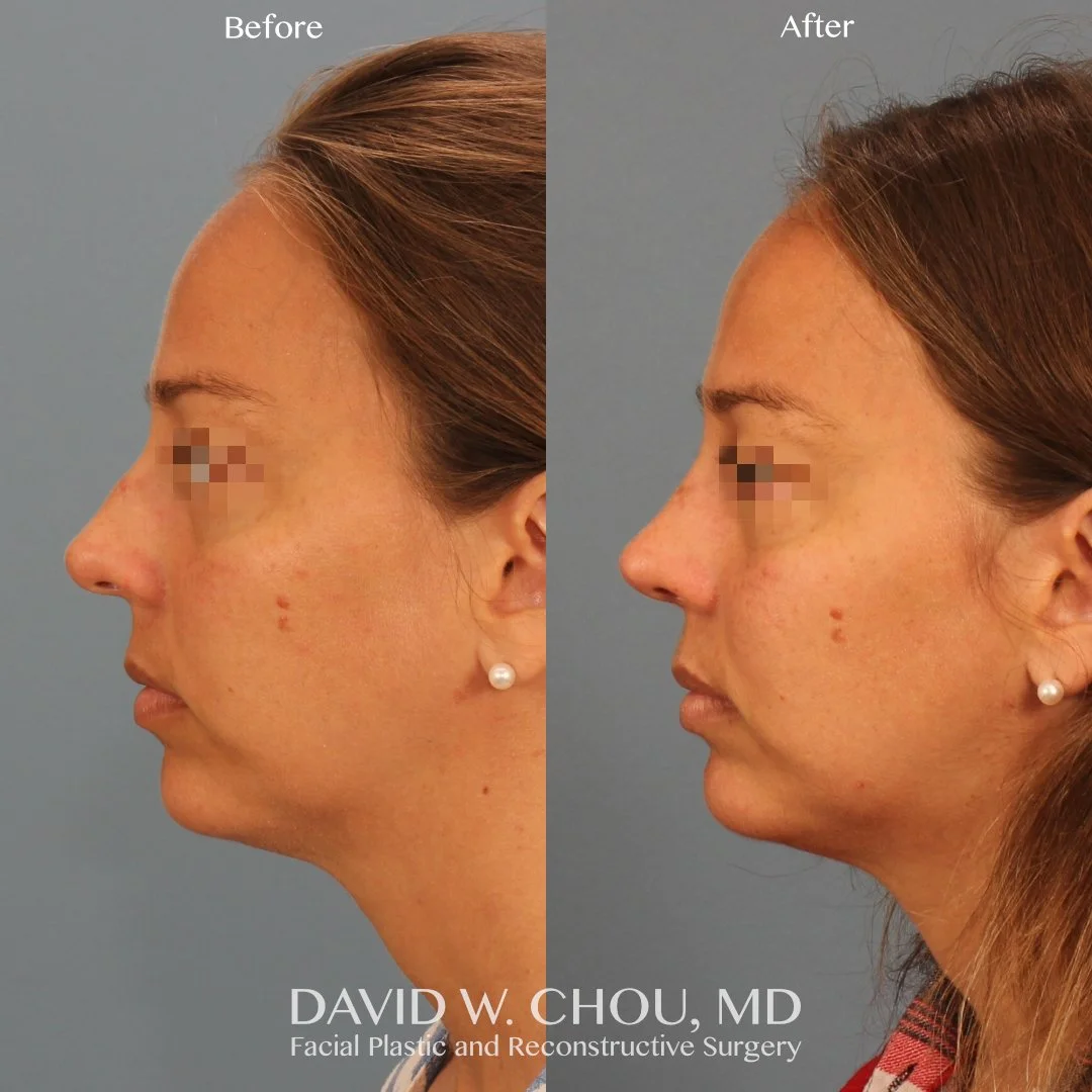 left lateral blur.jpg