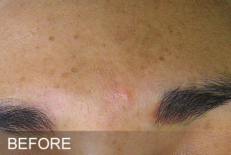 Brown-Spots-Before.jpg