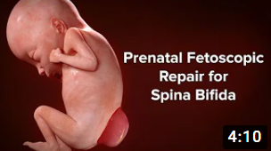 Spina Bifida Fetal Surgery Video (Copy)
