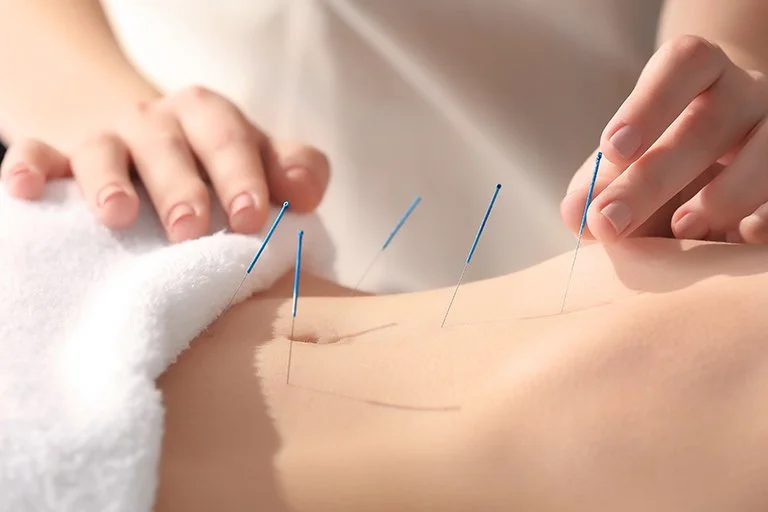 Fertility Acupuncture: Revitalizing Your Reproduction System