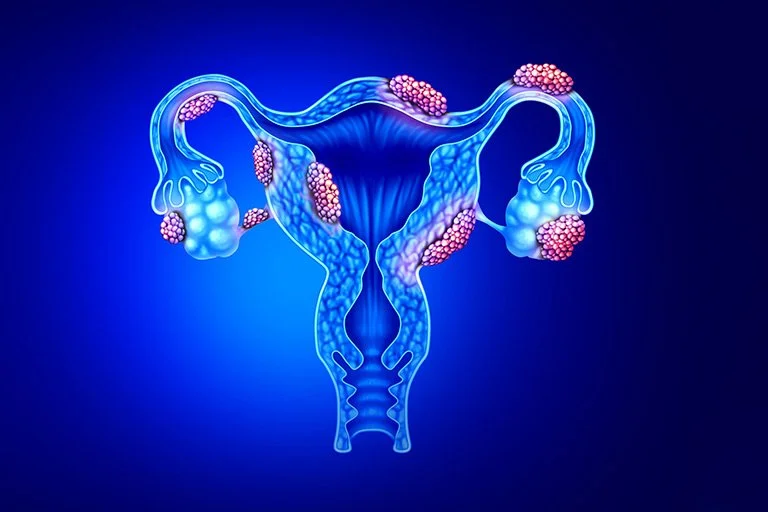 Endometriosis: How Does It Affect Fertility