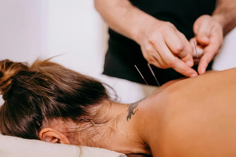 Unwinding the Mind: Acupuncture for Stress and Anxiety Relief