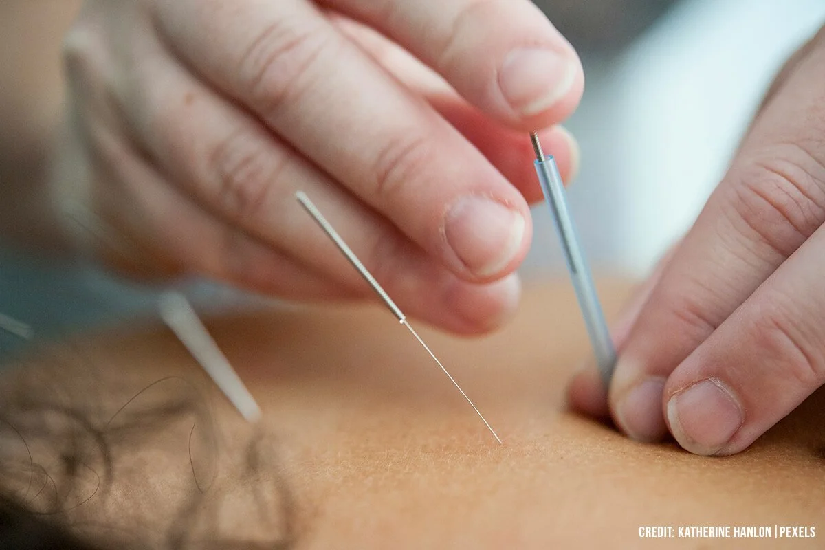 How Acupuncture and TCM Can Help Patients with High FSH