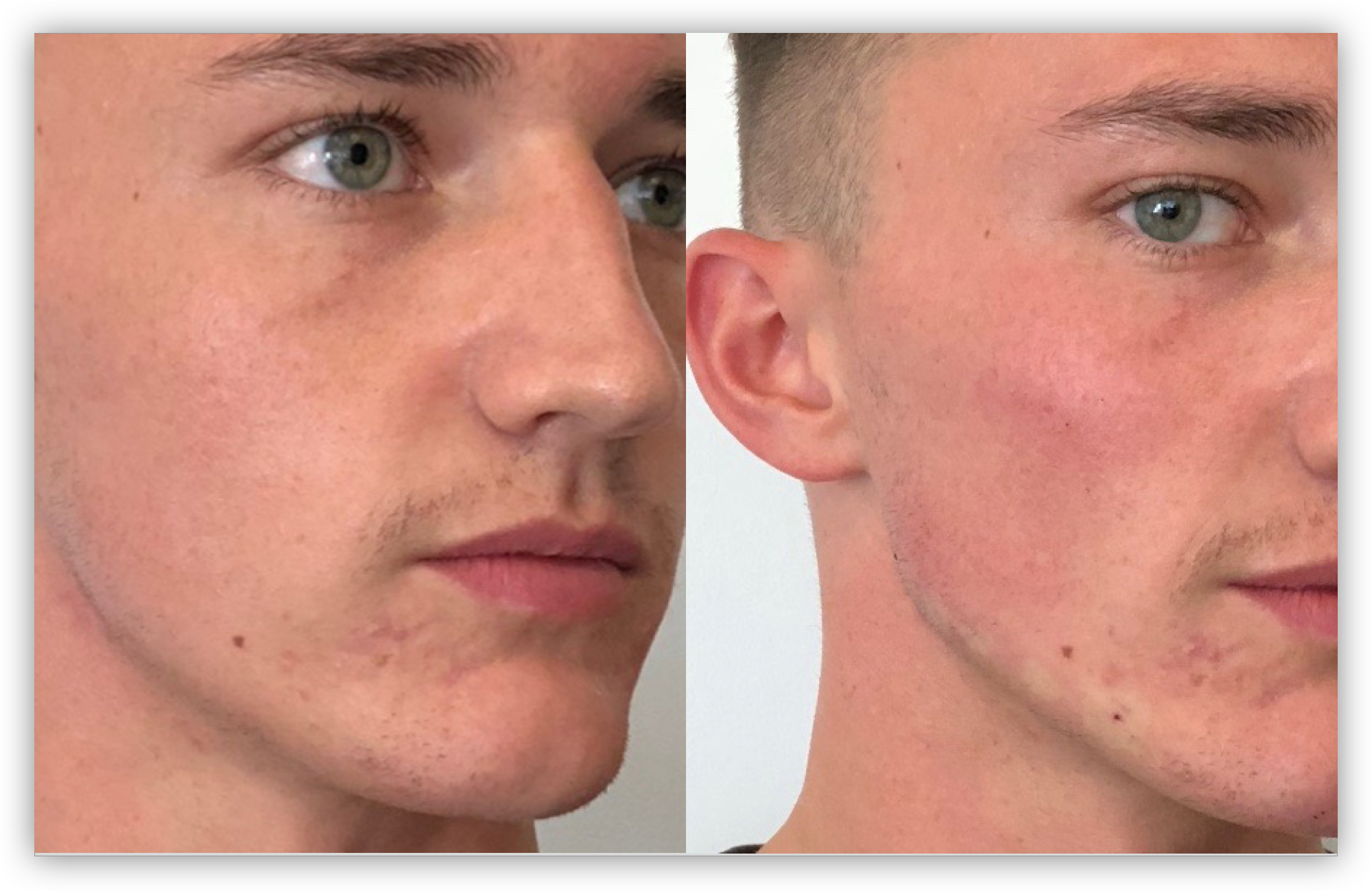 Male Jawline Enhancement