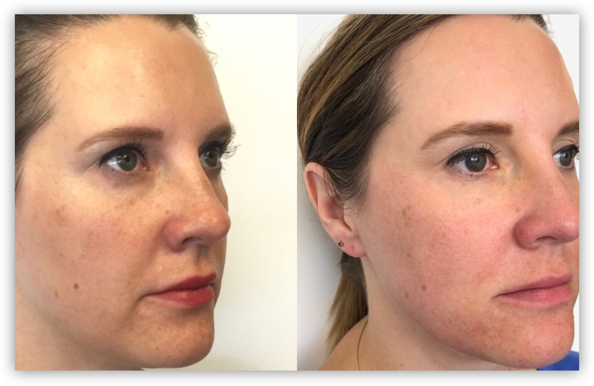 Fraxel Laser Treatment for Skin Tightening