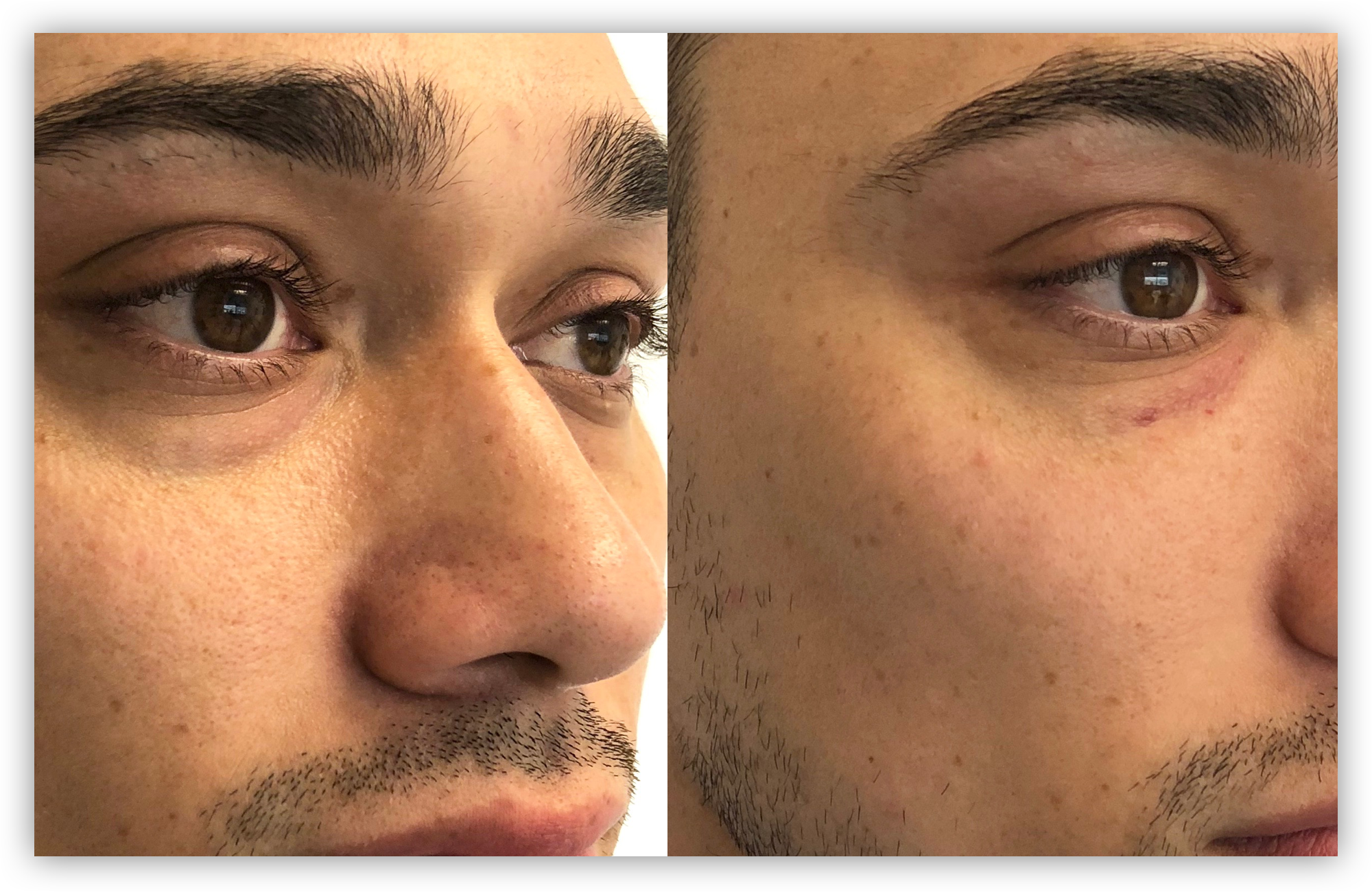 Under Eye Filler for Dark Circles