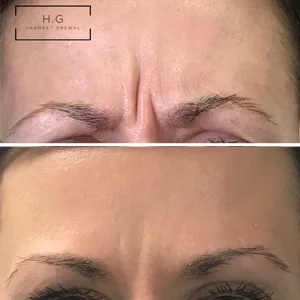 wrinkle-relaxation-injections.jpg
