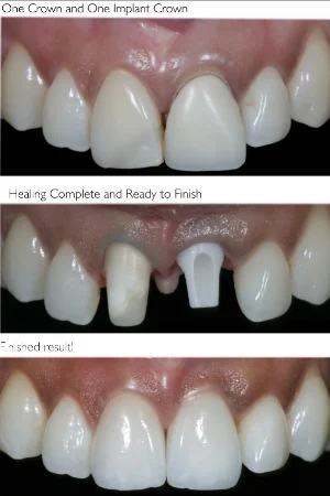 dental-implants-before-and-after.jpg