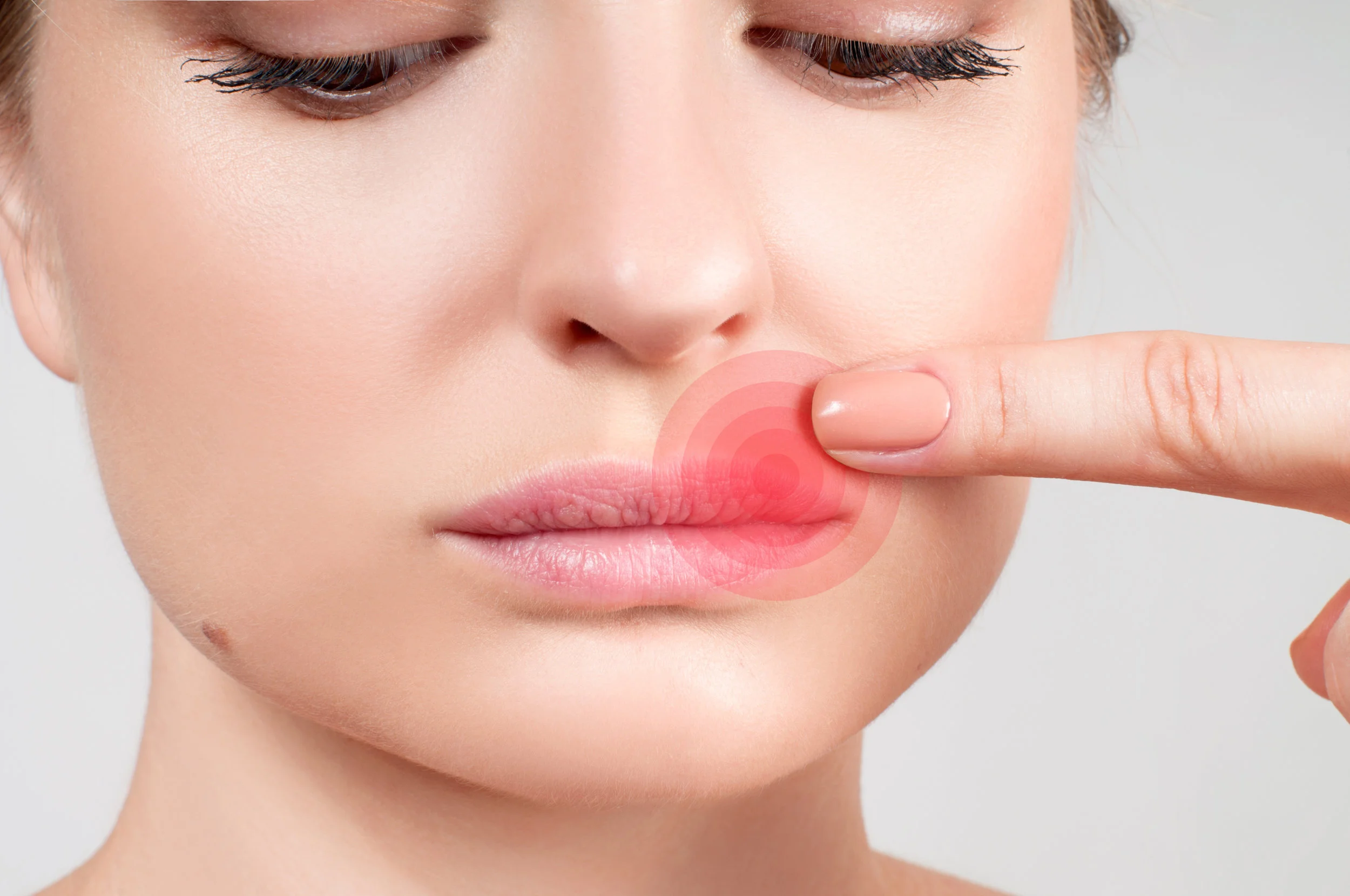 Management and Treatment of Cold Sores