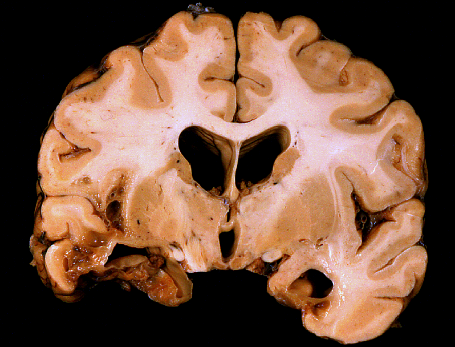 Chronic bilateral temporal damage from trauma. Note unilateral atrophy of the mammillary body due to loss of fornix input. 