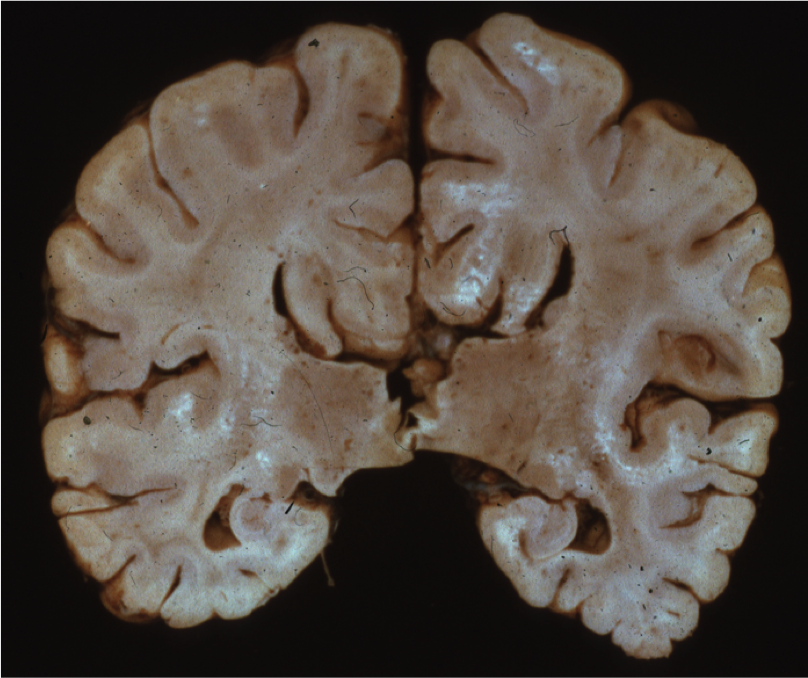 Agenesis of the corpus callosum in an adult