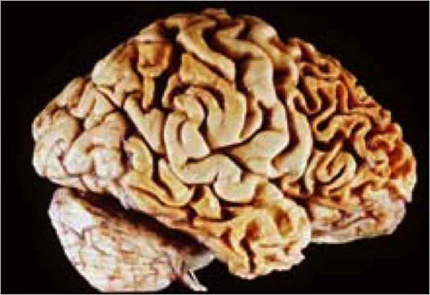 Knife-like atrophy of the frontal lobe in fronto-temporal dementia