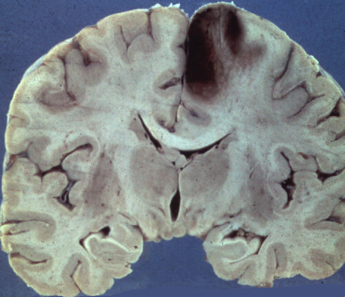 Hemorrhagic stroke in the anterior cerebral artery involving medial prefrontal cortex