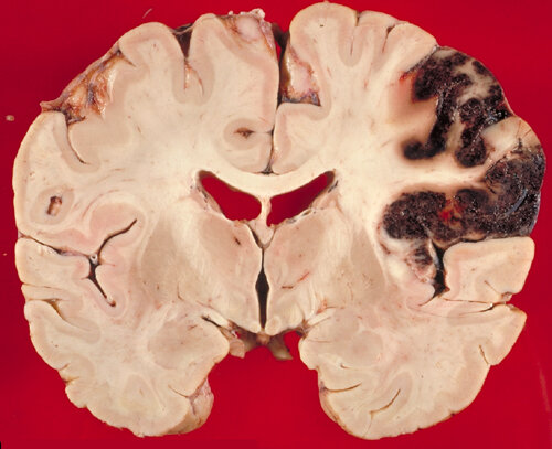 Hemorrhagic stroke in the middle cerebral artery involving middle and inferior frontal gyri