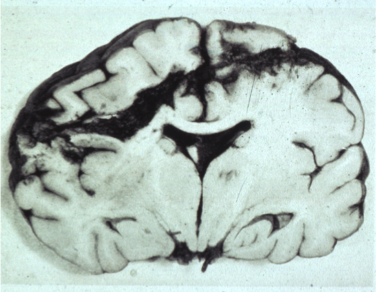 Bullet through frontal lobe