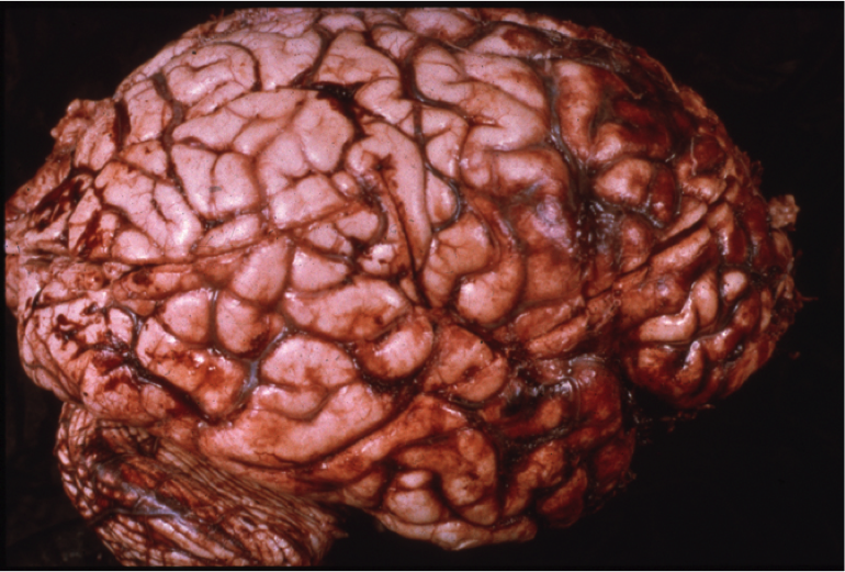 Temporal lobe contusions from traumatic brain injury