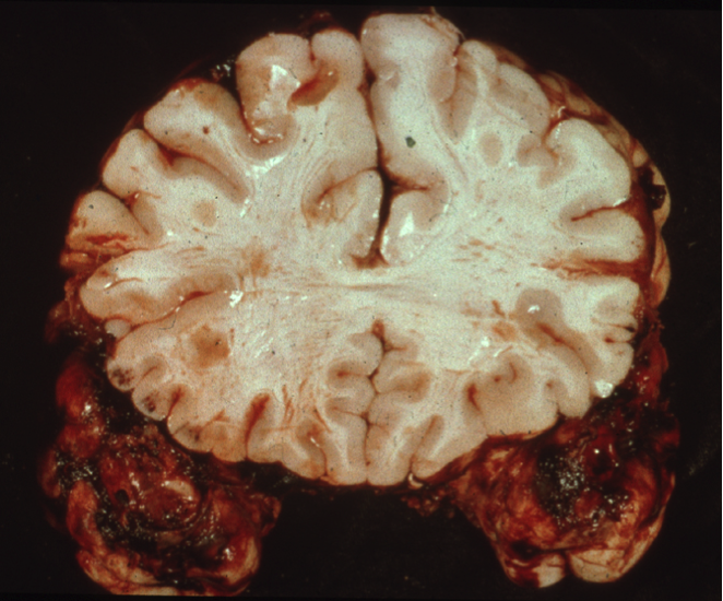 Temporal lobe contusions from traumatic brain injury 