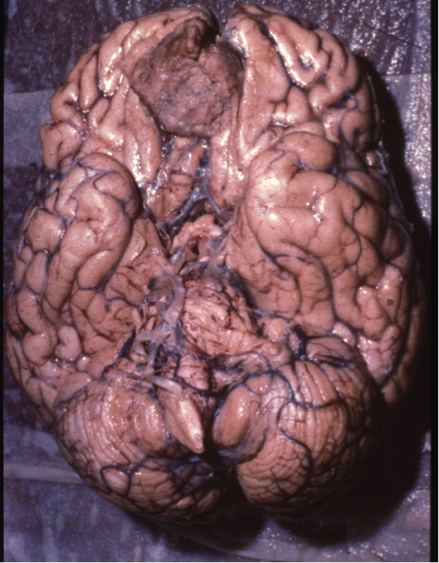 Massive frontal meningioma