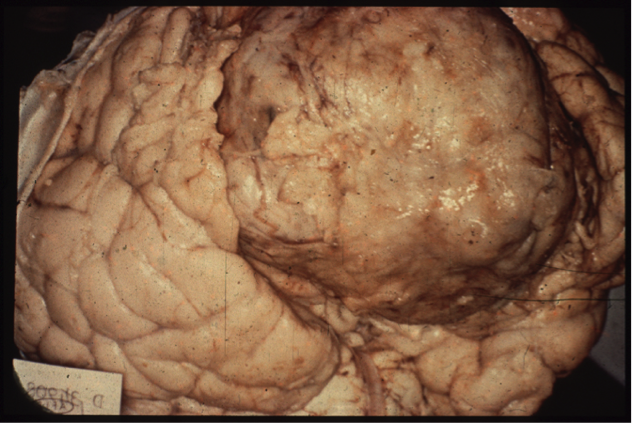 Massive frontal meningioma