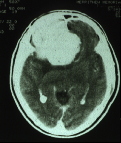 Massive frontal meningioma