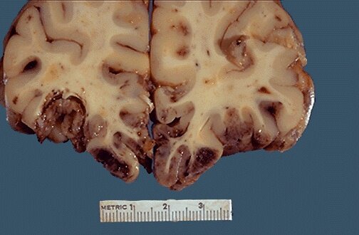 Acute extensive hemorrhages in bilateral orbitofrontal cortex secondary to traumatic brain injury