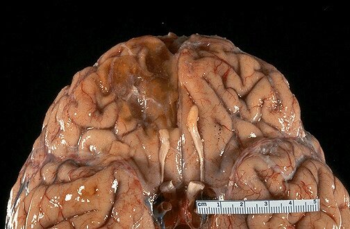 Chronic unilateral orbitofrontal damage from trauma. Note damage to olfactory bulb on the side of tissue loss