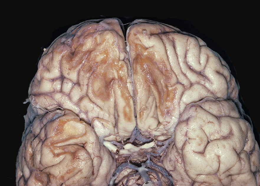 Chronic orbitofrontal contusion