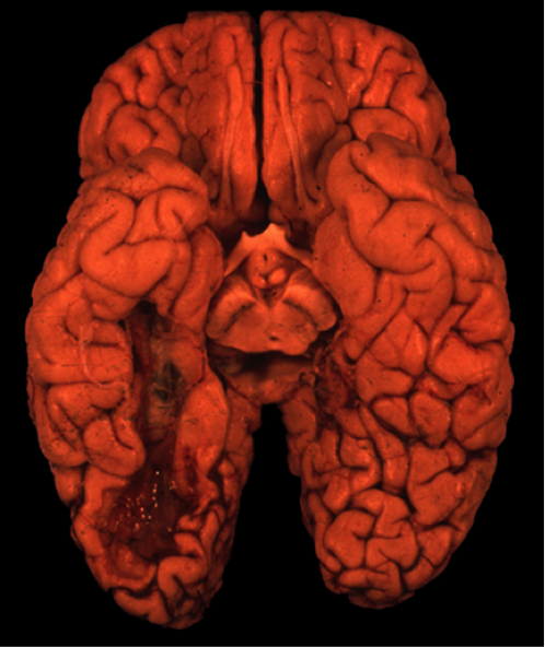 Posterior cerebral artery stroke