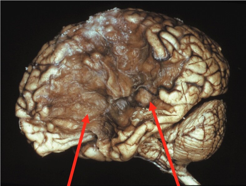 Chronic infarction.  Entire distribution of the middle cerebral artery