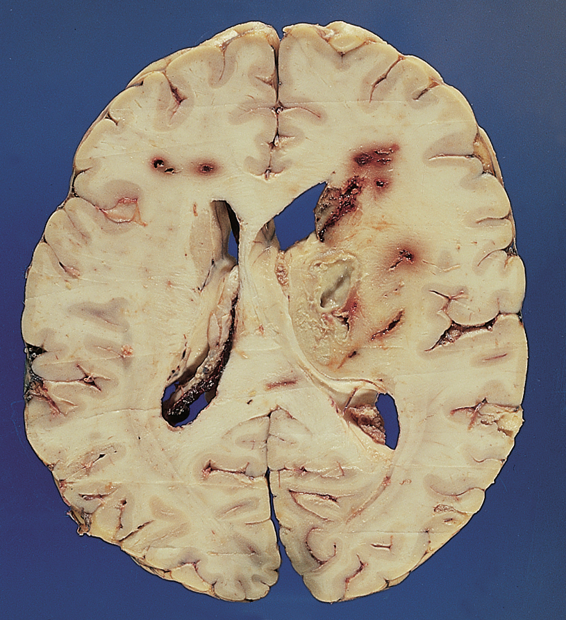 Bacterial brain abcess in the depth of the frontal lobe