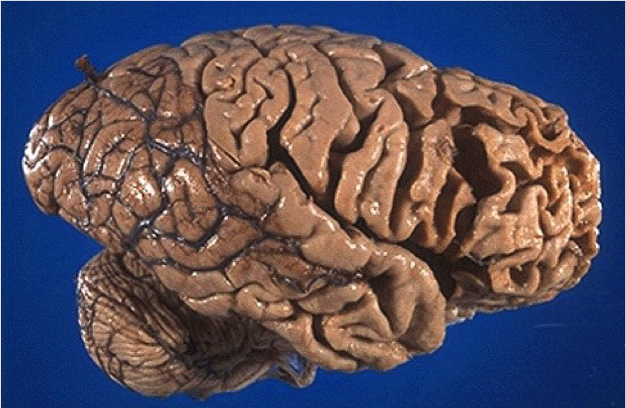 Frontotemporal dementia: prominent lateral frontal atrophy