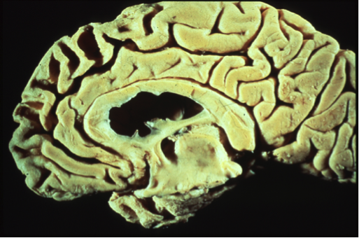 Frontotemporal dementia: prominent medial frontal atrophy