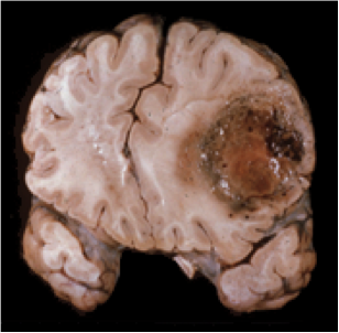 Glioblastoma in lateral frontal lobe