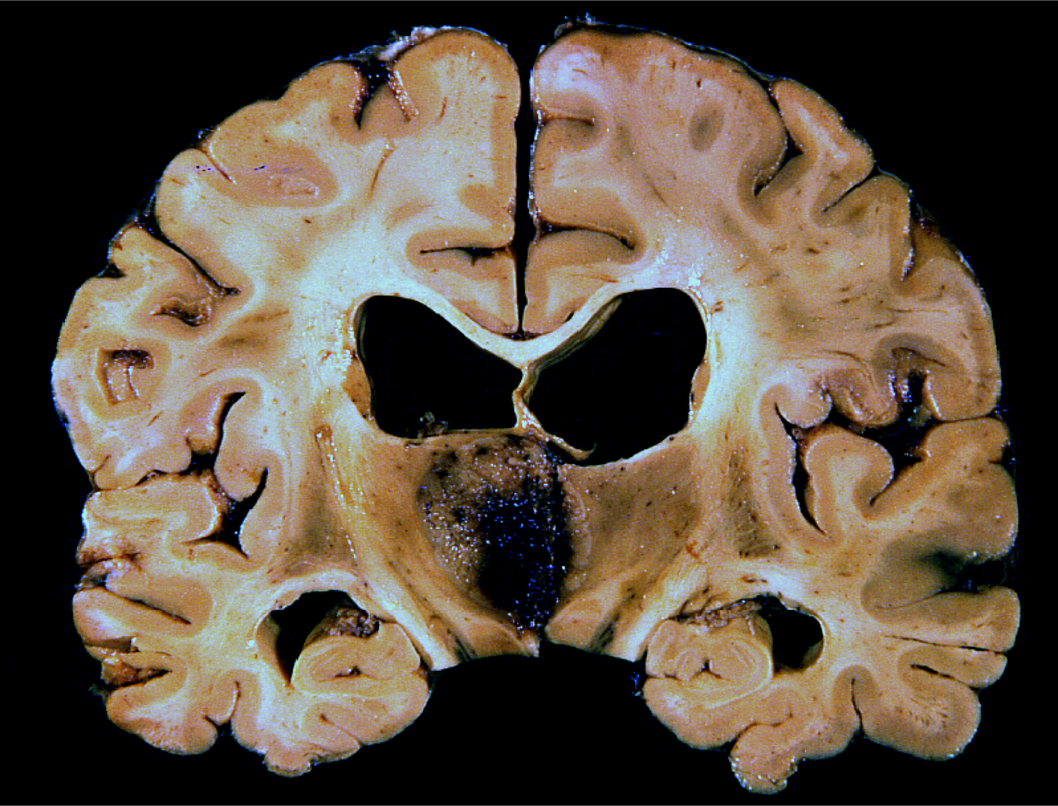 Thalamic glioblastoma