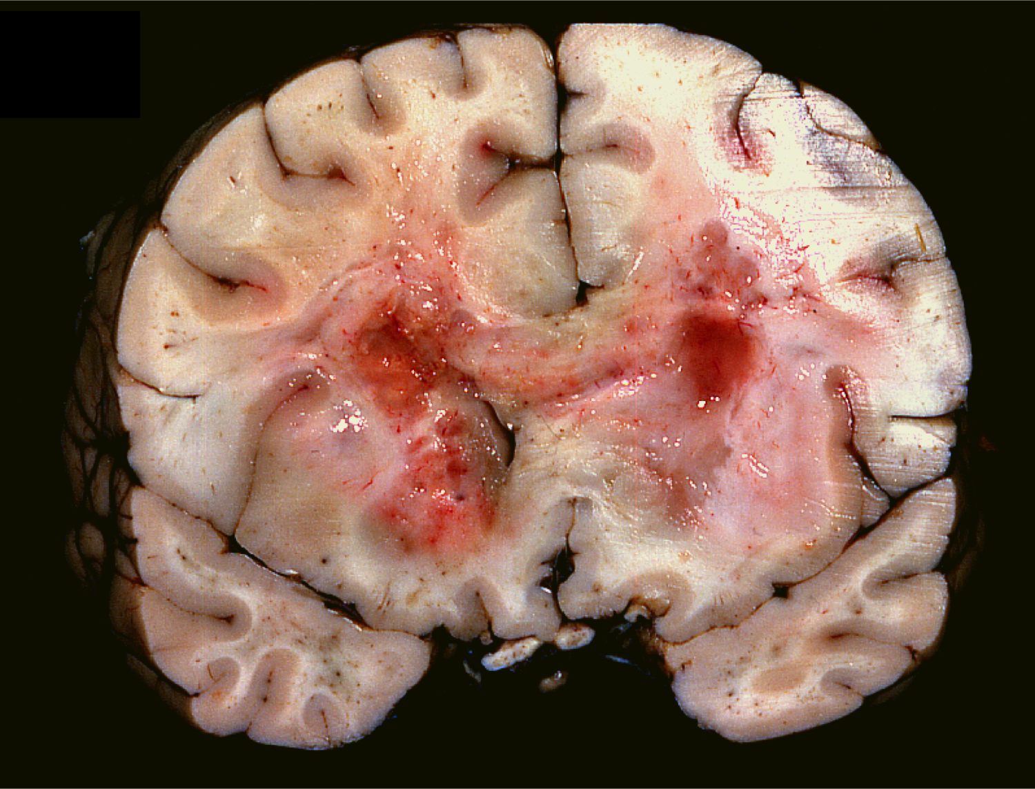 'Butterfly glioma' in the frontal lobe. Note tumor has spread through the corpus callosum