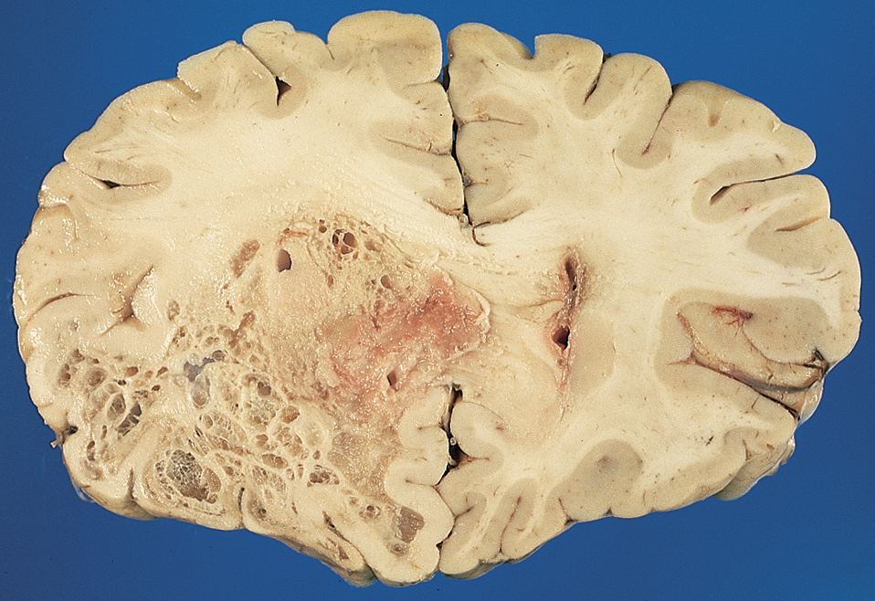 Multicystic glioblastoma centered in orbitofrontal cortex
