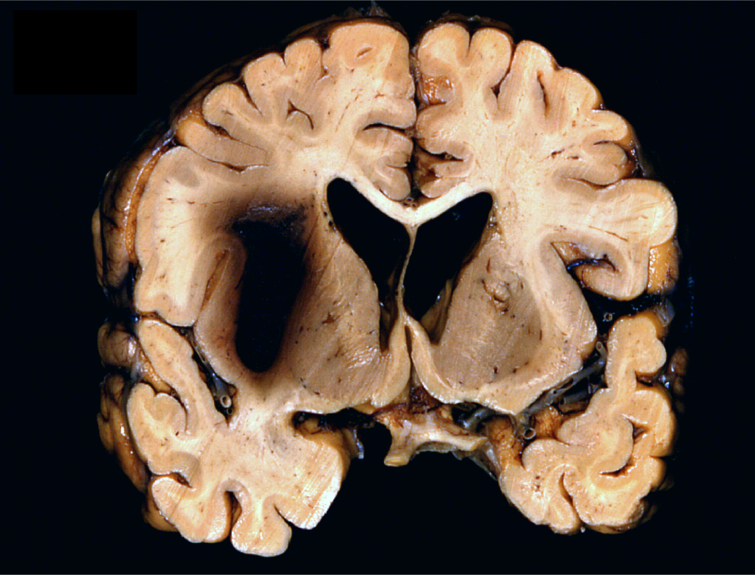 Basal ganglia hemorrhage from hypertension