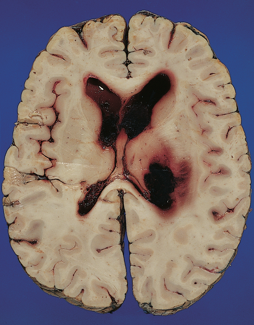 Pulvinar hemorrhage due to hypertension