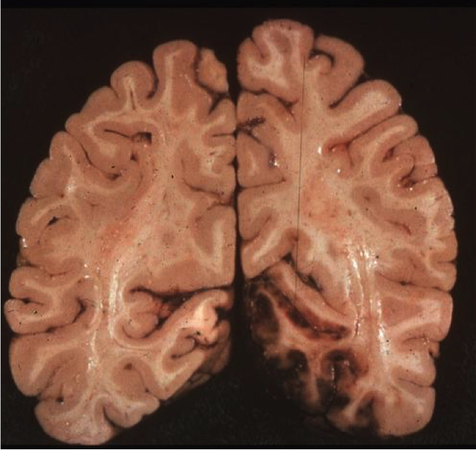 Hemorrhagic stroke posterior cerebral artery