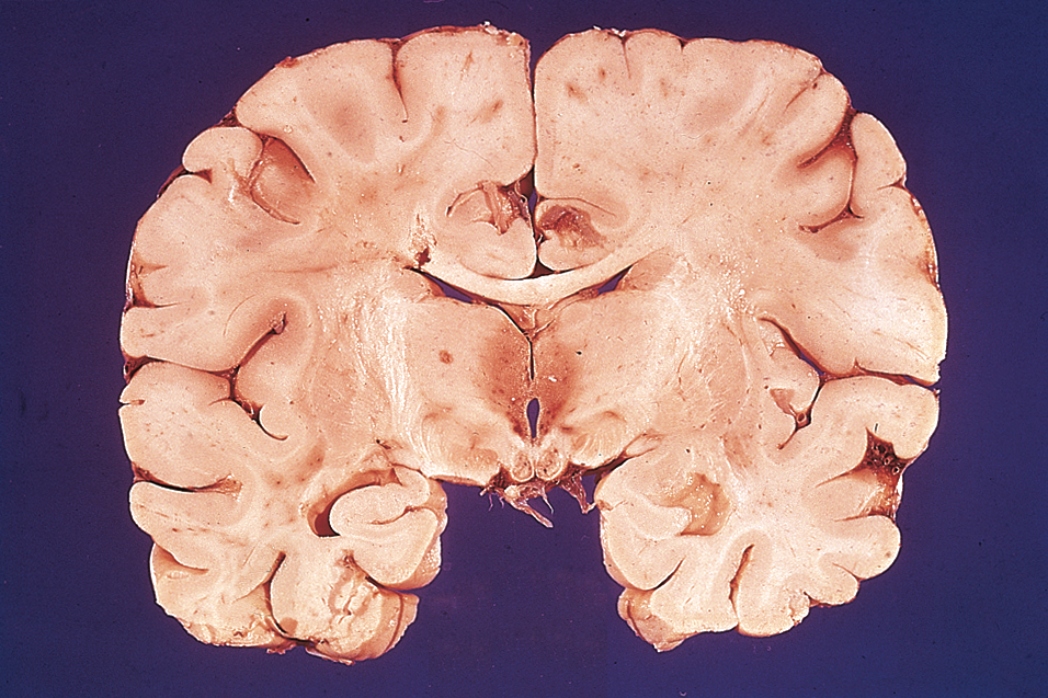 Acute Wernicke-Korsakoff. Note petechial hemorrhages in the mammillary bodies and thalamus