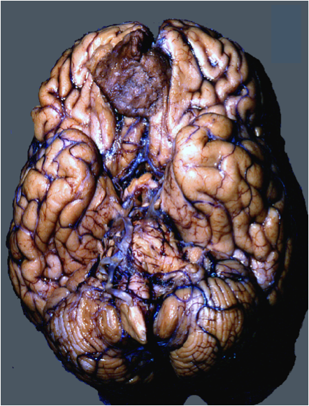 Orbitofrontal meningioma