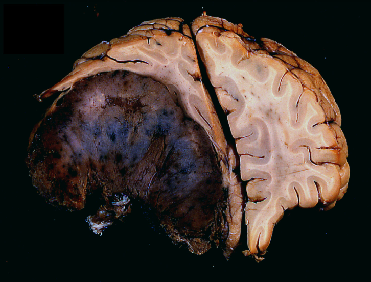 Massive orbitofrontal meningioma