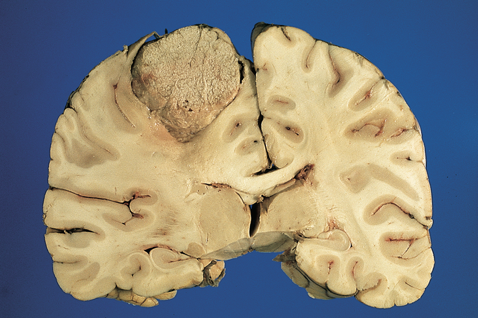 Parasaggital meningioma