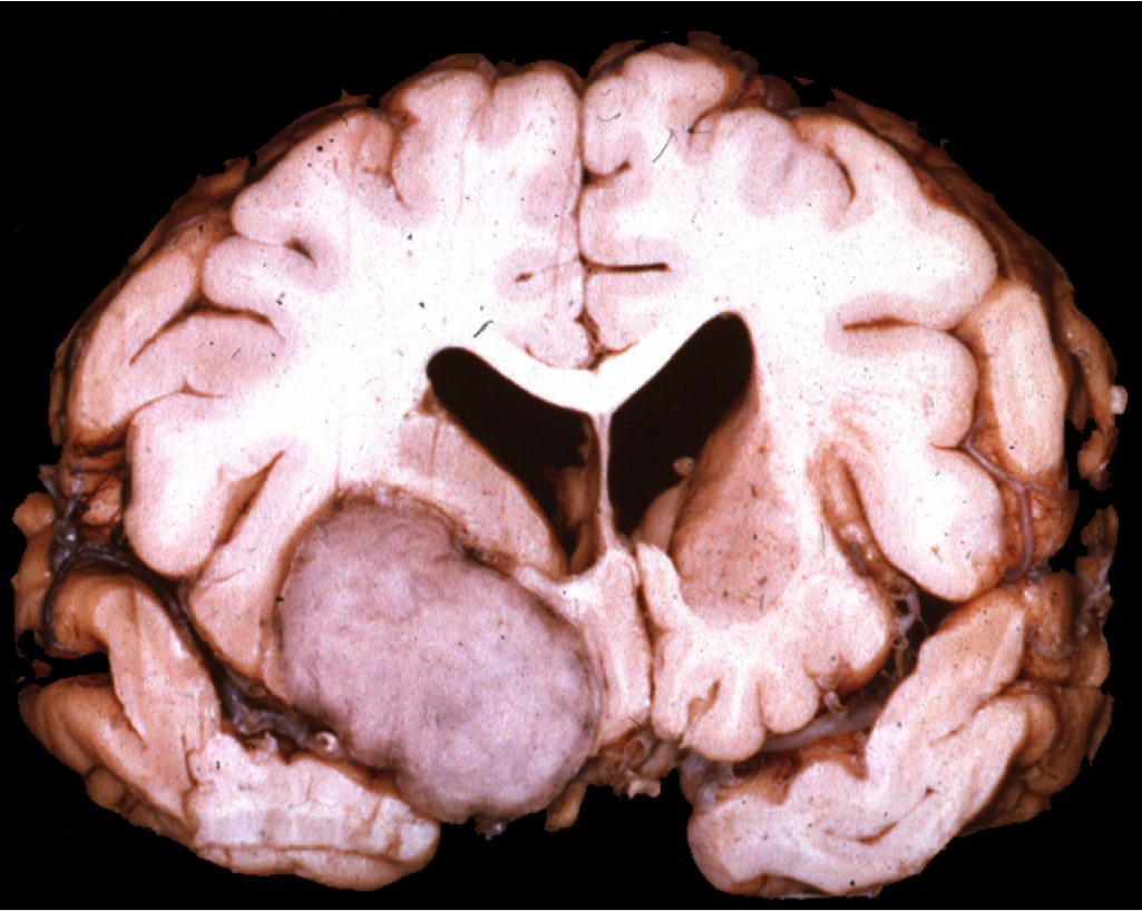 Orbitofrontal meningioma