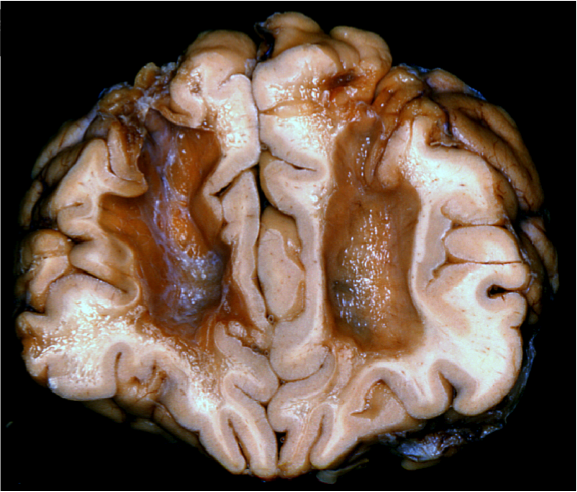 Bilateral frontal leucotomy for treatment of psychiatric disorders. Note massive damage to white matter in frontal lobe