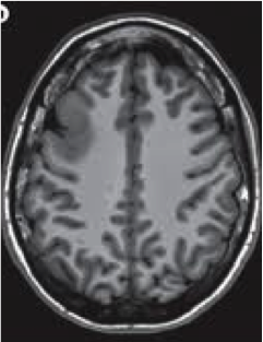 Focal cortical dysplasia in the lateral frontal lobe