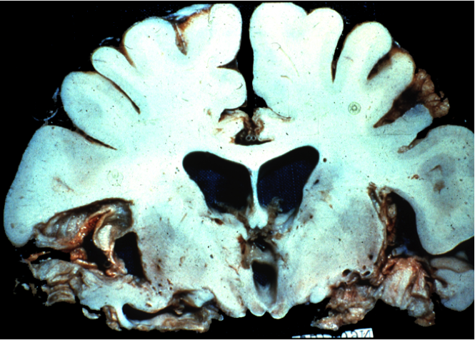 Chronic Herpes Simplex Encephalitis with Kluver-Bucy syndrome